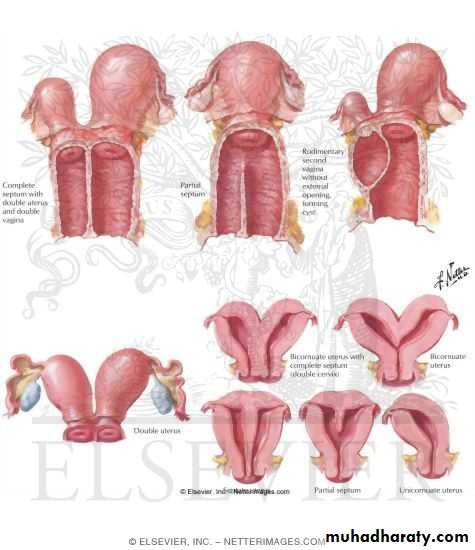 Abnormal Development Of Female Genital Tract Pptx Muhadharaty