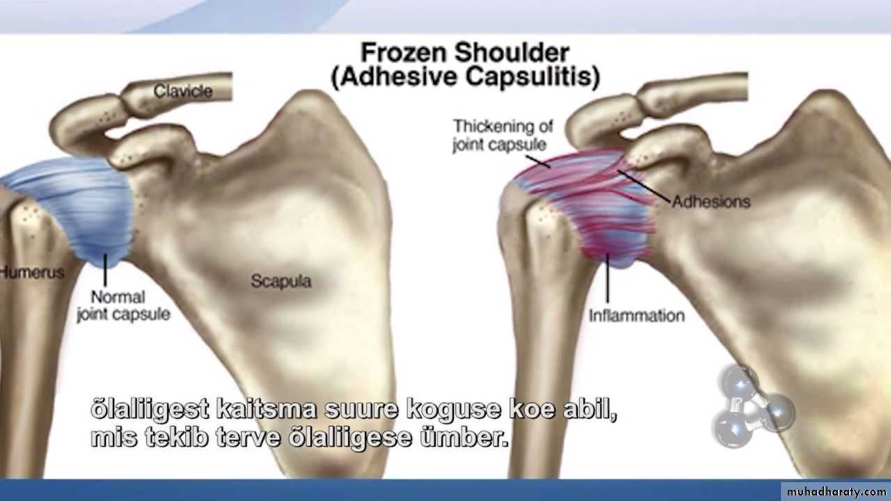 Периартрит Плечевого Сустава Лечение — Buy-artox.ru