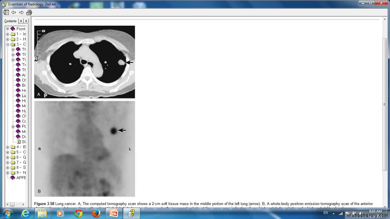 Lung Tumor Pptx D Majeed Muhadharaty