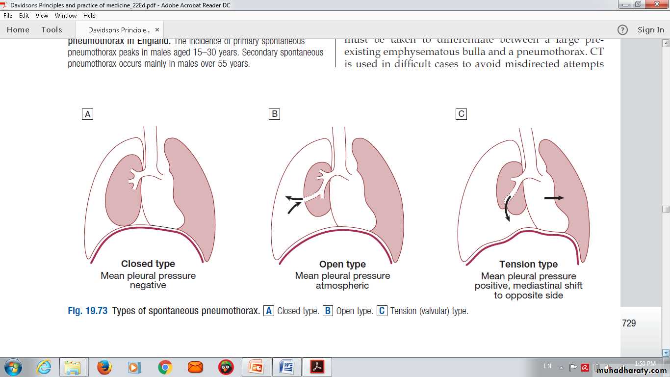 Pneumothorax Pptx D Majeed Muhadharaty