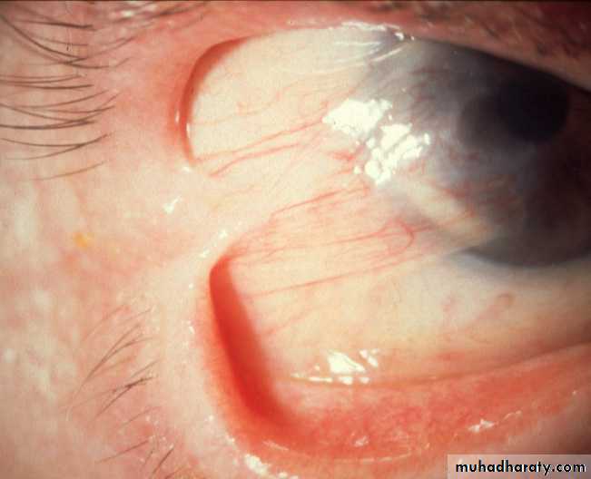 Keratoconus Pptx - عزام - Muhadharaty