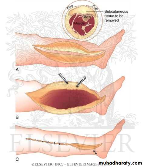 Arterial Disorders pptx - د. زيد - Muhadharaty