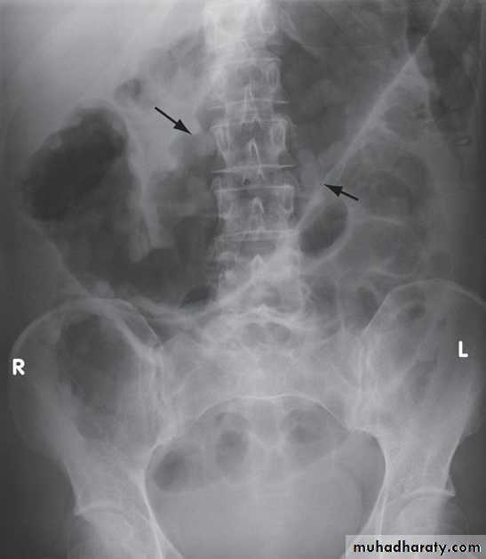 IBD pptx - دكتور حسن اسماعيل - Muhadharaty