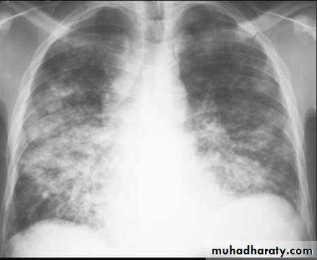 Pneumonia Pptx - دكتور حسن اسماعيل - Muhadharaty