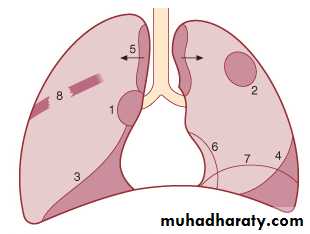Ca lung pptx - دكتور حسن اسماعيل - Muhadharaty