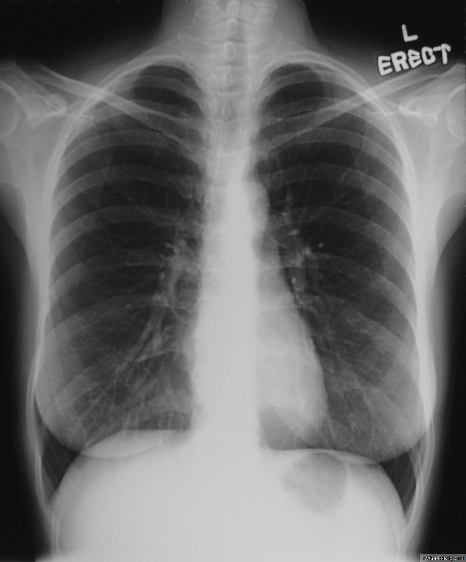 Interstitial Lung Diseae pptx - دكتور حسن اسماعيل - Muhadharaty