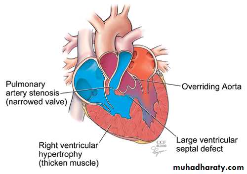 Cyanotic congenital heart disease pptx - د. محمد دحام - Muhadharaty