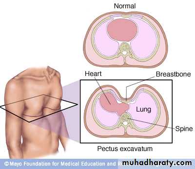 Abnormal Chest Shape