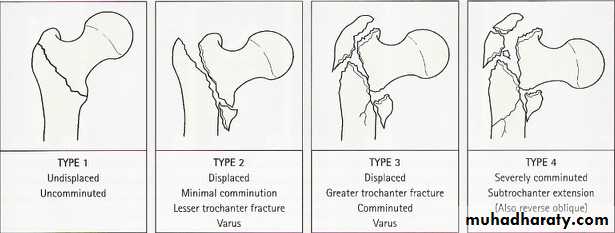 fractures of femoral neck pptx - دكتور يونس - Muhadharaty