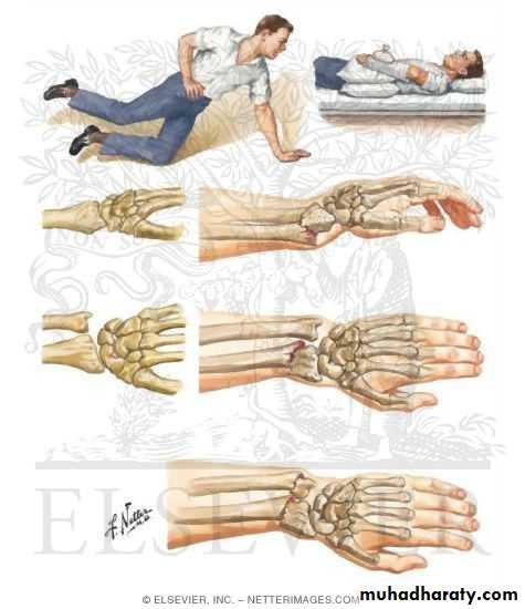 fractures of wrist and hand pptx - دكتور يونس - Muhadharaty