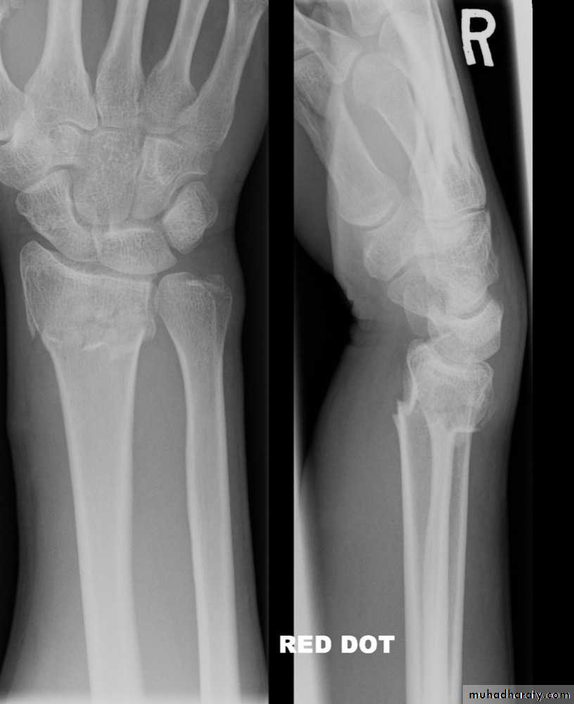 Fractures Of Wrist And Hand Pptx - دكتور يونس - Muhadharaty