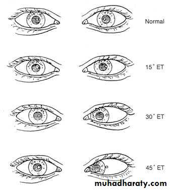 Strabismus docx - د.اسامه - Muhadharaty