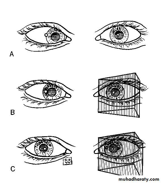 Strabismus docx - د.اسامه - Muhadharaty