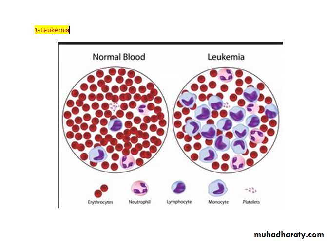 Leukaemias docx - دكتور مهيب - Muhadharaty