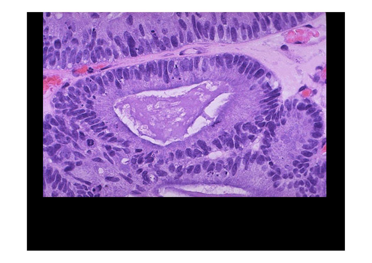 Аденома с высокой неоплазией. Аденокарцинома толстой кишки гистология. Тубулярная аденома толстой кишки гистология. Аденокарцинома Толстого кишечника гистология. Опухоль толстой кишки микропрепарат.