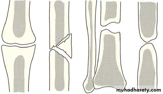 Factors affecting and help bone healing pptx - دمحمود خضير - Muhadharaty