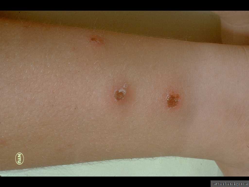 Bacterial Skin Rash 9 Common Infections - vrogue.co