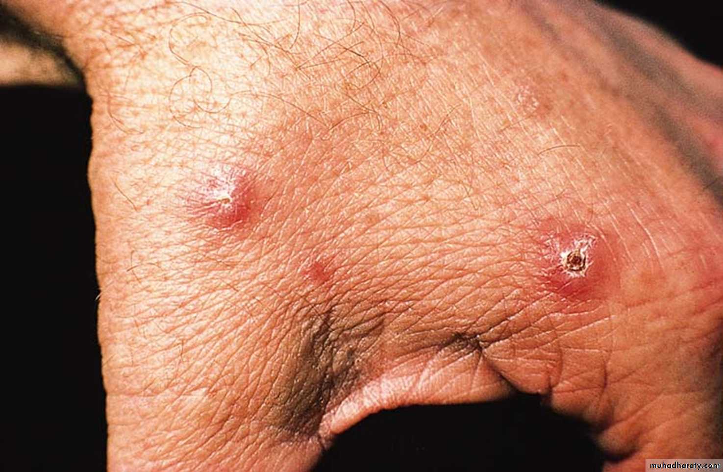 Parasitic Skin Diseases Pptx د سلام التميمي Muhadharaty