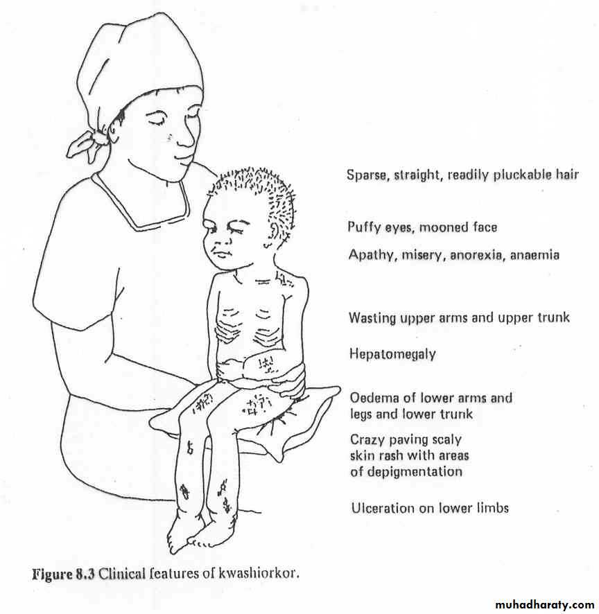 Malnutrition pptx - د.مازن الجادري - Muhadharaty