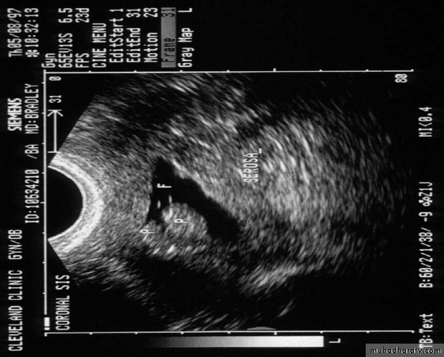 post-menopausal-bleeding-pptx-muhadharaty