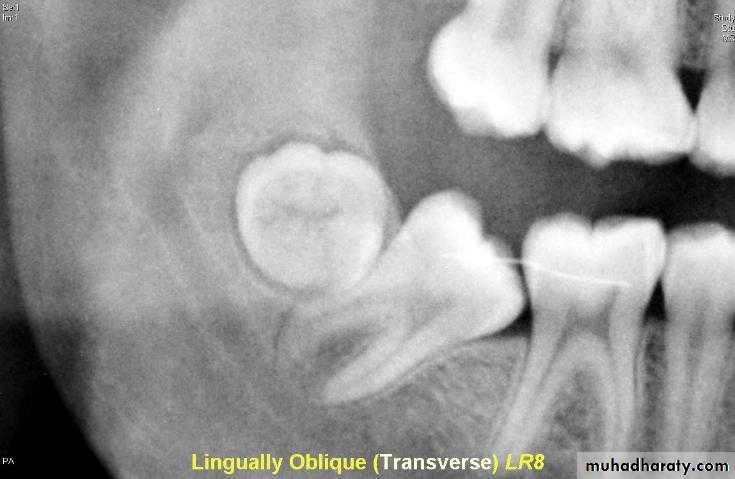 Impaction pptx - Dr.Fidaa - Muhadharaty