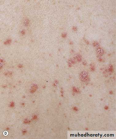 Psoriasis pptx - د. عمر - Muhadharaty