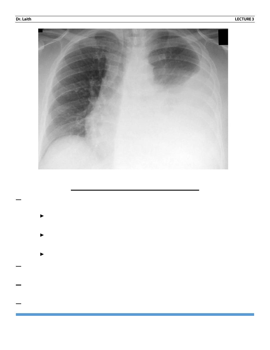 pleura x ray pdf - د. ليث - Muhadharaty