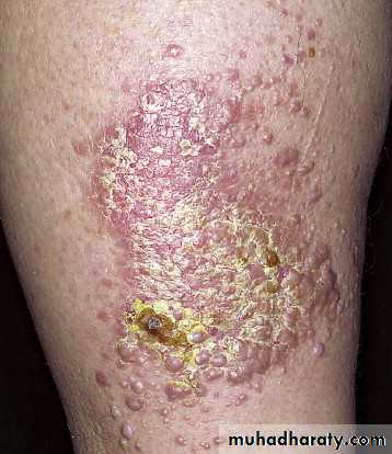 Psoriasis and other desieases pptx - د.عمر - Muhadharaty