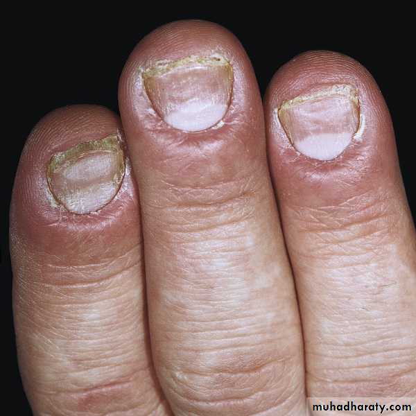 Superficial fungal infection pptx - د.عمر - Muhadharaty