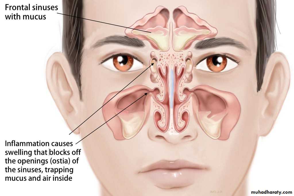 Acute And Chronic Rhinitis Docx Muhadharaty