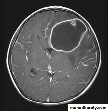 INTRACRANIAL SPACE OCCUPYING LESION docx - د.علي الشالجي - Muhadharaty