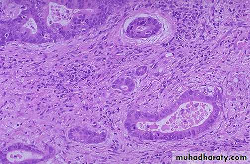 Neoplasia pptx - د.ندوة - Muhadharaty