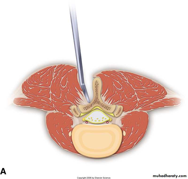 Lumbar Spine Canal Stenosis Pptx - د. منير خماس - Muhadharaty