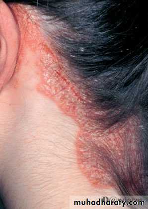 psoriasis pptx - د.صبيح - Muhadharaty