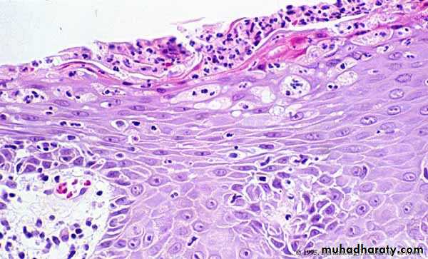 psoriasis pptx - د.صبيح - Muhadharaty