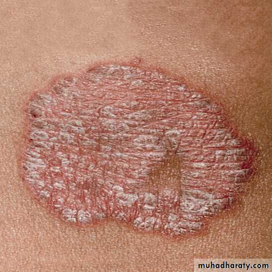 psoriasis pptx - د.صبيح - Muhadharaty