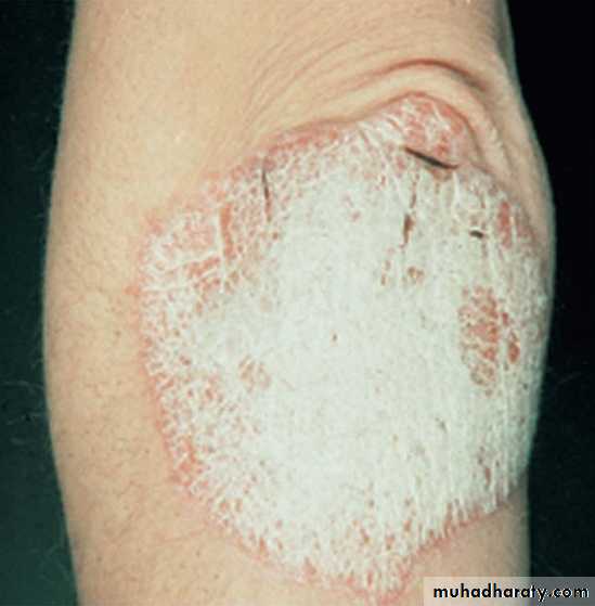 psoriasis pptx - د.صبيح - Muhadharaty