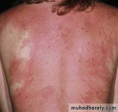 urticaria docx - د.عمر - Muhadharaty