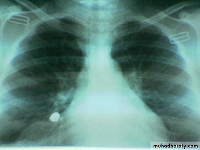 INTRA CARDIAC BULLET WITH INTRA VASCULAR PULMONARY EMBOLIZATION pptx ...