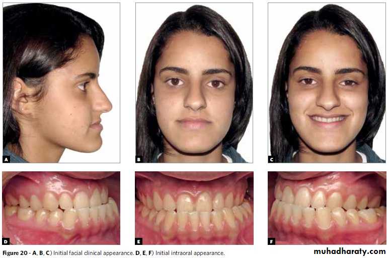 Extraoral appliances pptx - Dr.younis - Muhadharaty