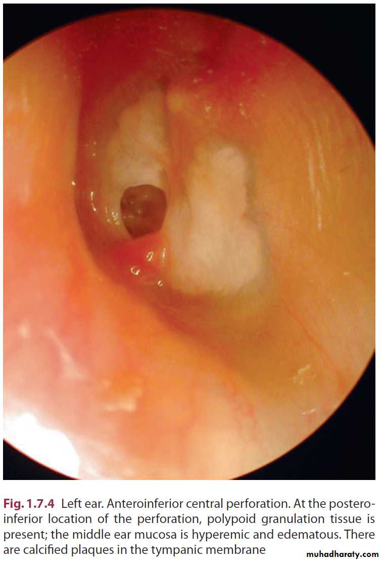 Disease of middle ear pptx - د. احمد محي - Muhadharaty