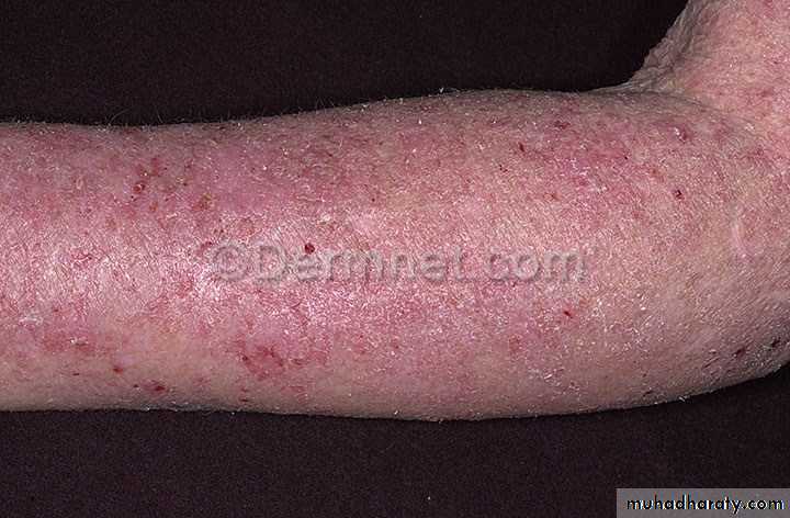 Eczema pptx - د. عمر - Muhadharaty