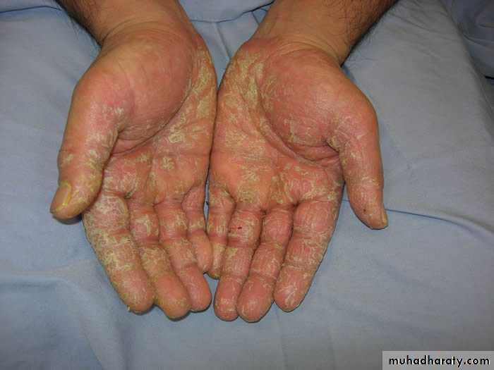 Eczema pptx - د. عمر - Muhadharaty