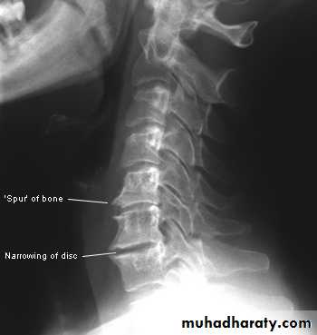 lumber disc prolapse pptx - د.محمد الموسوي - Muhadharaty