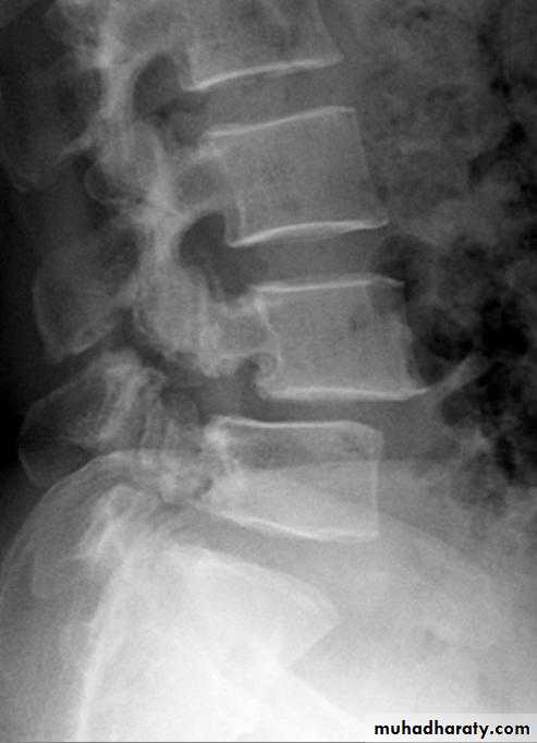 lumber disc prolapse pptx - د.محمد الموسوي - Muhadharaty