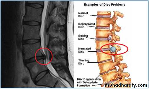 lumber disc prolapse pptx - د.محمد الموسوي - Muhadharaty