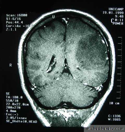 Neurosurgery pptx - د. عبدالرحمن - Muhadharaty