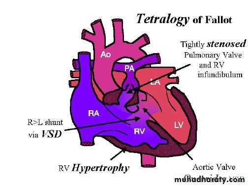 Cynotic congenital heart disease pptx - د.منيرة - Muhadharaty