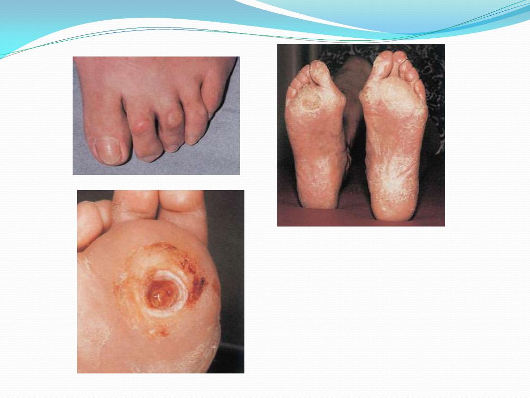 Diabetic Foot Pdf Muhadharaty