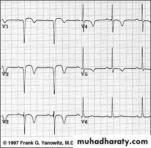 2 THE 12 LEADS STNDARD ECG docx - د. اروى - Muhadharaty